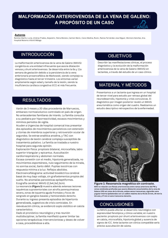 P.09. Malformación arteriovenosa de la vena de Galeno: a propósito de un caso